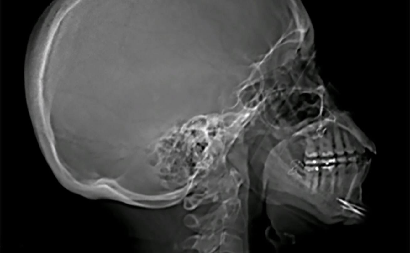 X-ray of a head